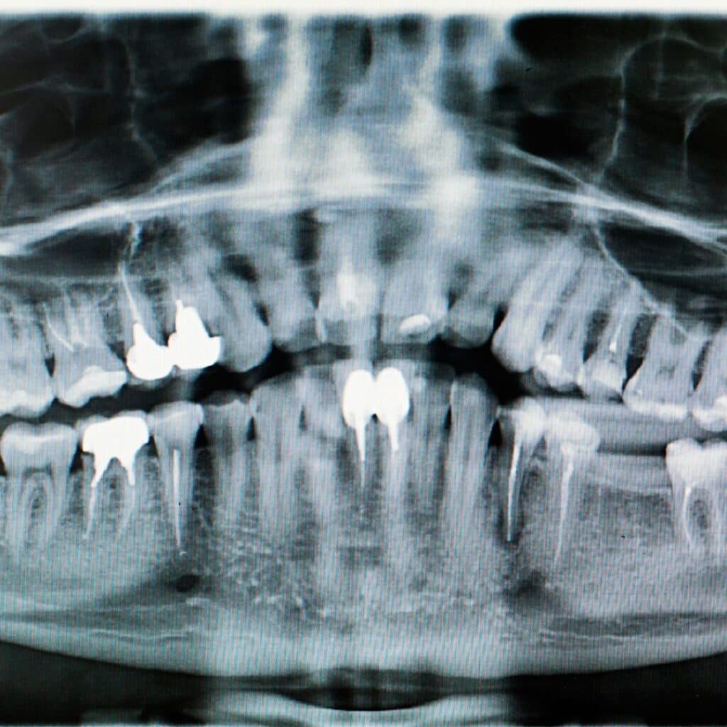 What Do Dental X Rays Tell You About Your Oral Health Primary Dental